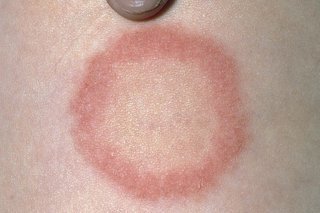 Person with ringworm on their arm, showing red, irritated skin. 